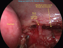 Thermal Ablation to Treat Cancer
